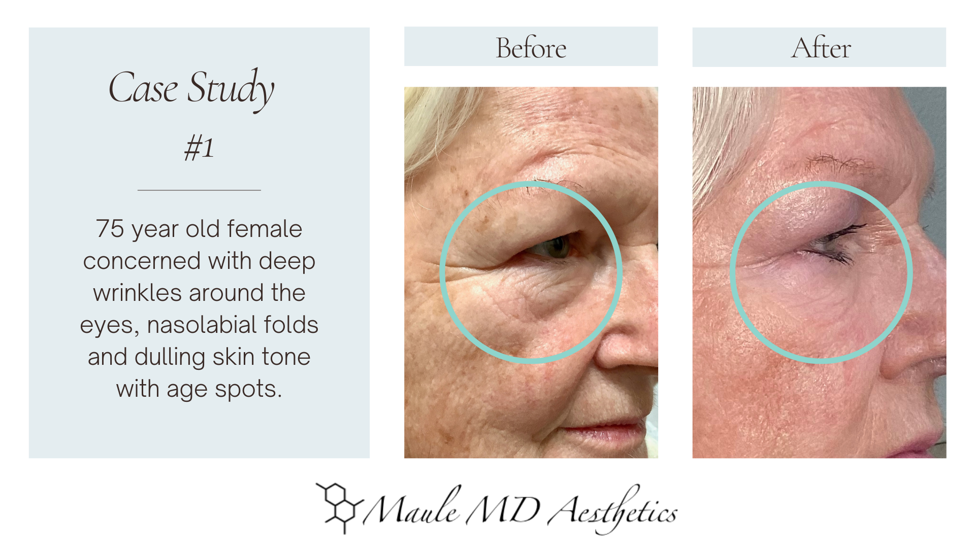 Non-Surgical Facelift Case Study — Before and After